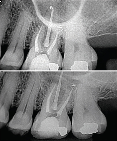 Resective and regenerative periodontal therapy for maxillary Class II furcation defect: A case report with 24-month follow-up.