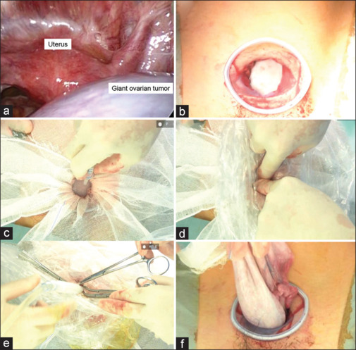 Management of Large Ovarian Tumors in Elderly Patients Using the Aron Alpha Method and Principles of Enhanced Recovery after Surgery.