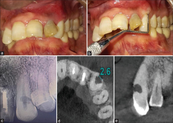 Surgical reconstruction of invasive external cervical root resorption with perforation and associated periodontal defect using novel bioceramic materials and cone beam computed tomography as a diagnostic adjunct- A case report.