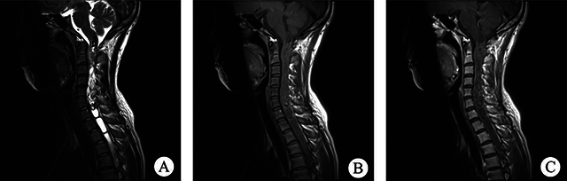 Analysis of Spinal Pilocytic Astrocytoma in 12 Case Reports and Literature Review.