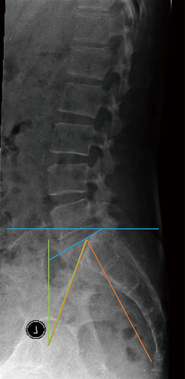 Five-year radiological outcomes between decompression alone and decompression with an interlaminar device for lumbar spinal stenosis.