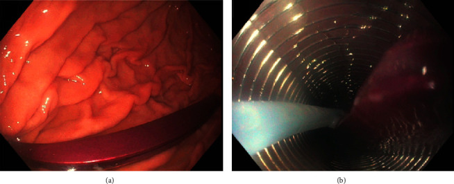 Fluoroscopic-Guided Removal of Jejunal Sharp Foreign Body: An Alternative Approach to Surgery.