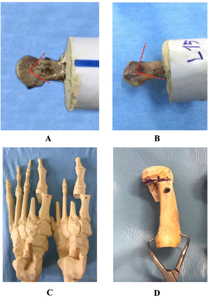 Biomechanical comparison of reverse offset-L osteotomy and chevron osteotomy in cadaveric hallux valgus surgery.