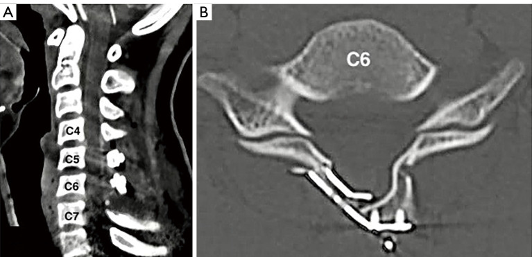 Spontaneous spinal epidural hematoma in children: a case report and literature review.