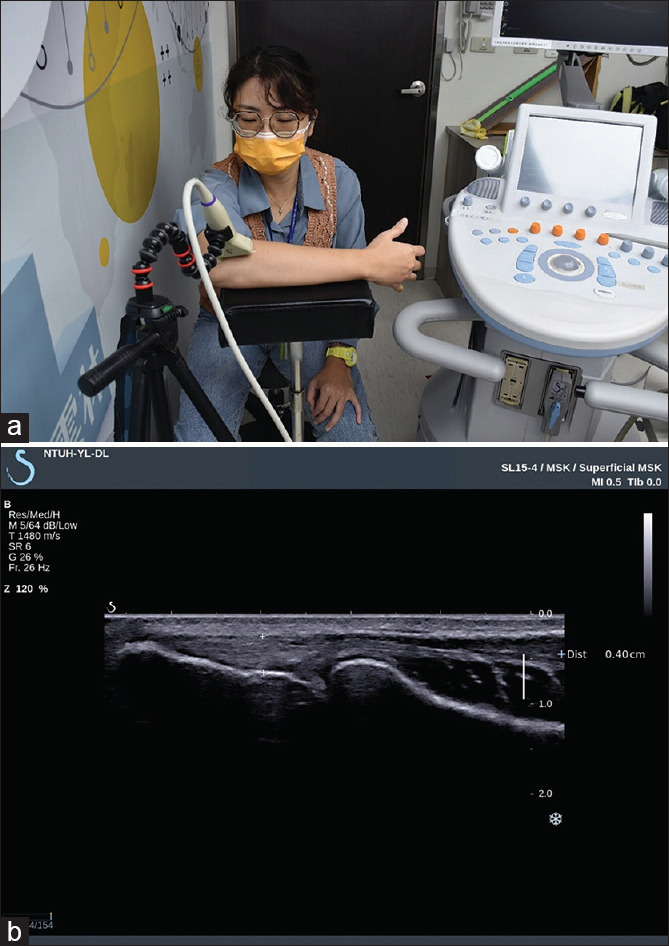 Evaluation and Surveillance of Lateral Elbow Tendinopathy in Manual Workers: Identifying Elbows at Risk.