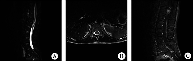 Analysis of Spinal Pilocytic Astrocytoma in 12 Case Reports and Literature Review.