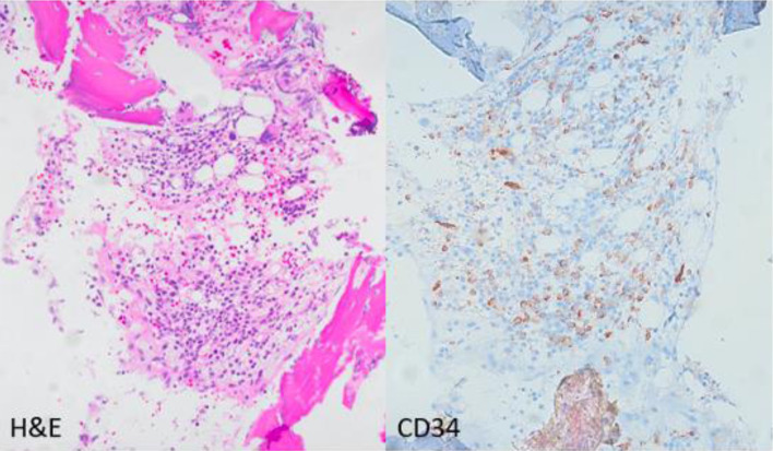 Clinical, Phenotypic and Molecular Characterization of <i>NUP214-ABL1</i> Fusion Positive Myeloid Malignancies.