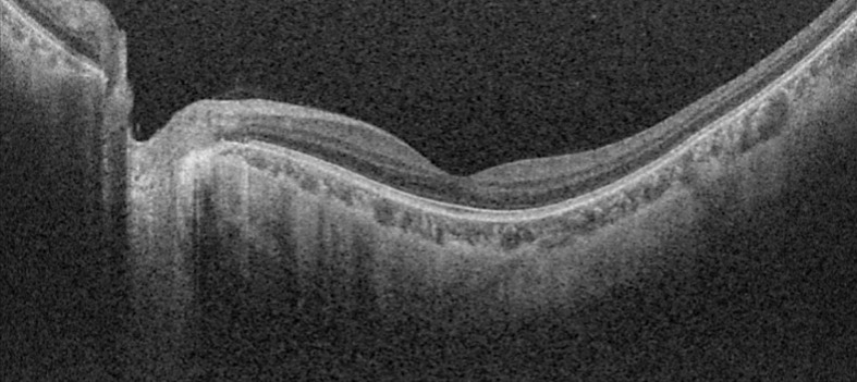 Roller Coasters and Retinal Detachment: Case Series and Review of Acceleration-Deceleration Retinal Injury.