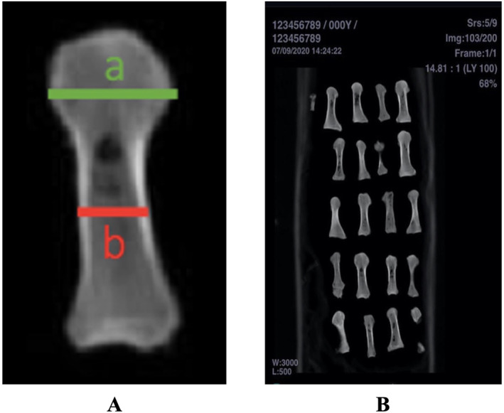 Biomechanical comparison of reverse offset-L osteotomy and chevron osteotomy in cadaveric hallux valgus surgery.