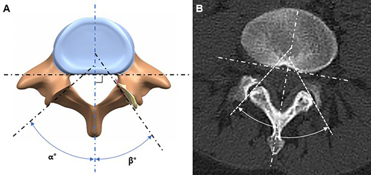 Mechanical influence of facet tropism in patients with chronic discogenic pain disorder.