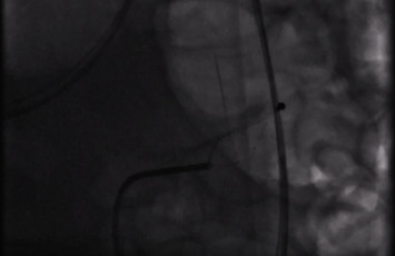 Fluoroscopic-Guided Removal of Jejunal Sharp Foreign Body: An Alternative Approach to Surgery.