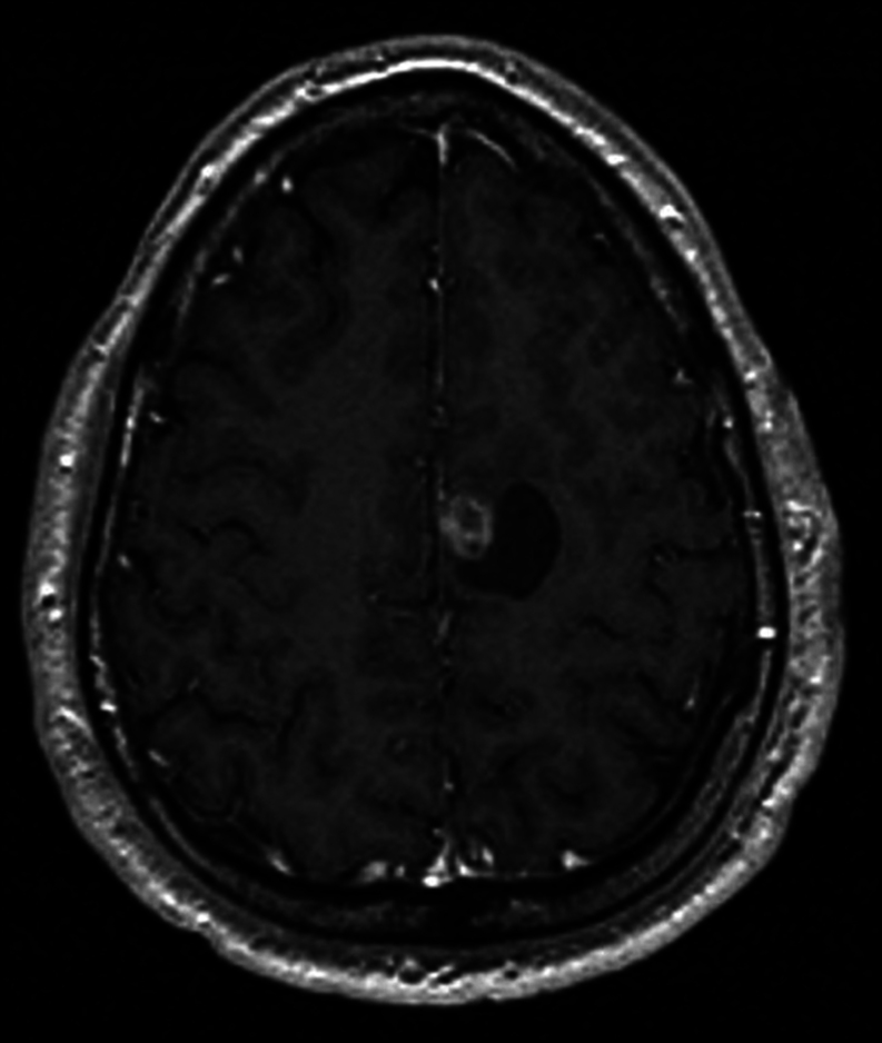 Brain metastasis mimicking a cavernous angioma as initial presentation of papillary thyroid carcinoma.