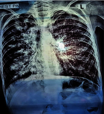 Case Study: Analyzing CFTR Mutations and SNPs in Pulmonary Fibrosis Patients with Unclear Symptoms.