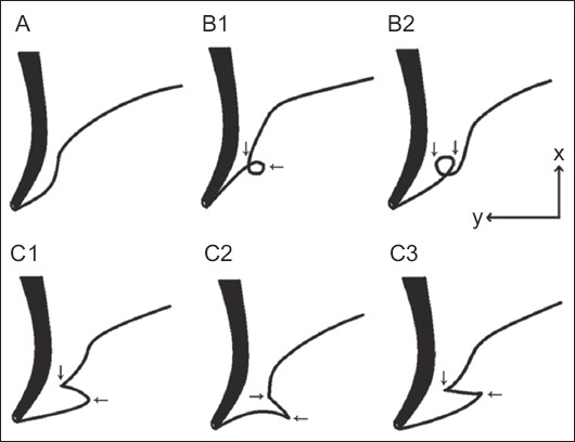 Meandering main pancreatic duct syndrome: a single-center cohort study and aggregated review.