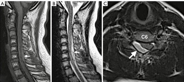 Spontaneous spinal epidural hematoma in children: a case report and literature review.