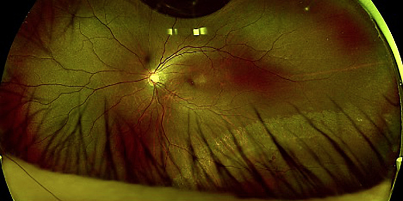 Roller Coasters and Retinal Detachment: Case Series and Review of Acceleration-Deceleration Retinal Injury.