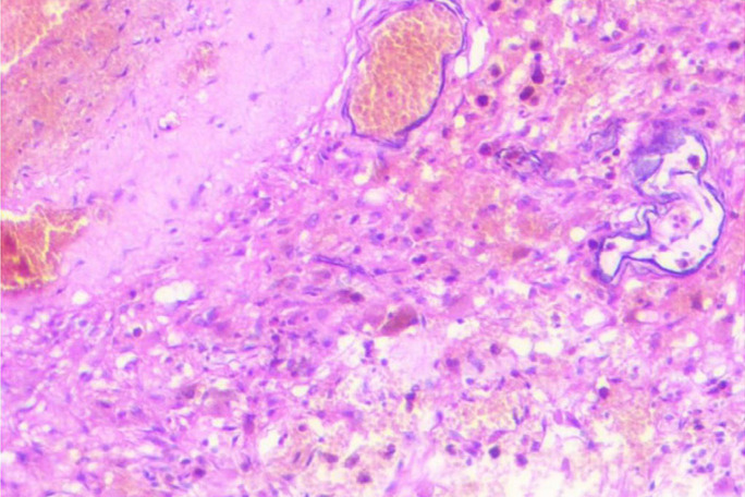 Giant cerebellar cavernous malformation in children: A case report and literature review.