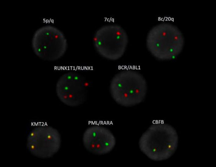 Clinical, Phenotypic and Molecular Characterization of <i>NUP214-ABL1</i> Fusion Positive Myeloid Malignancies.
