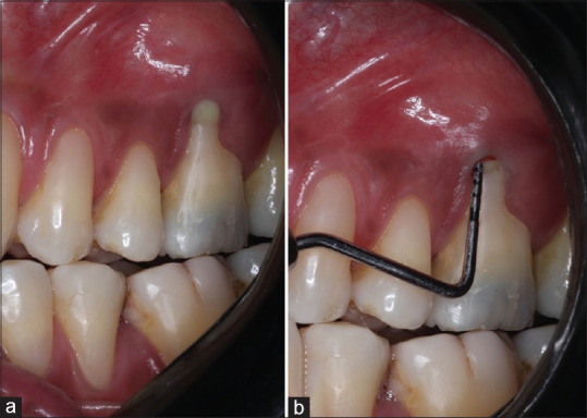 Resective and regenerative periodontal therapy for maxillary Class II furcation defect: A case report with 24-month follow-up.