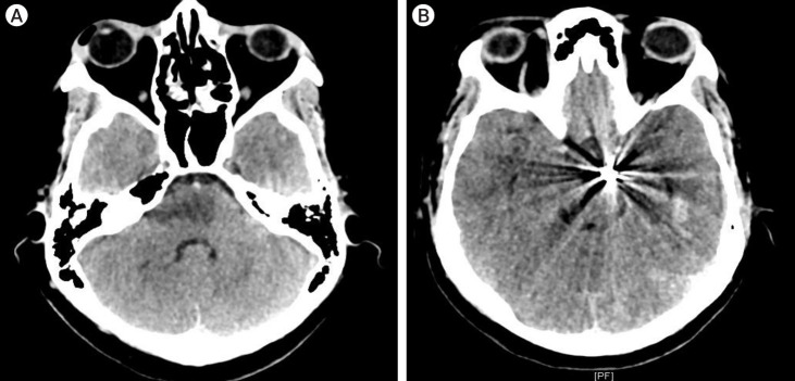 Isolated ipsilateral abducens nerve palsy and contralateral homonymous hemianopsia associated with unruptured posterior cerebral artery aneurysm: A rare neurological finding.