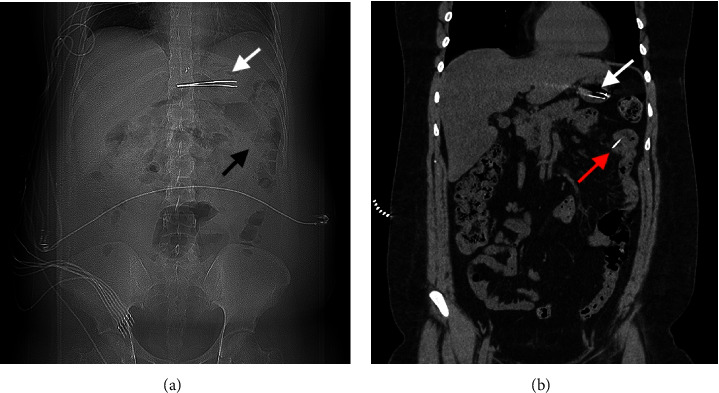 Fluoroscopic-Guided Removal of Jejunal Sharp Foreign Body: An Alternative Approach to Surgery.