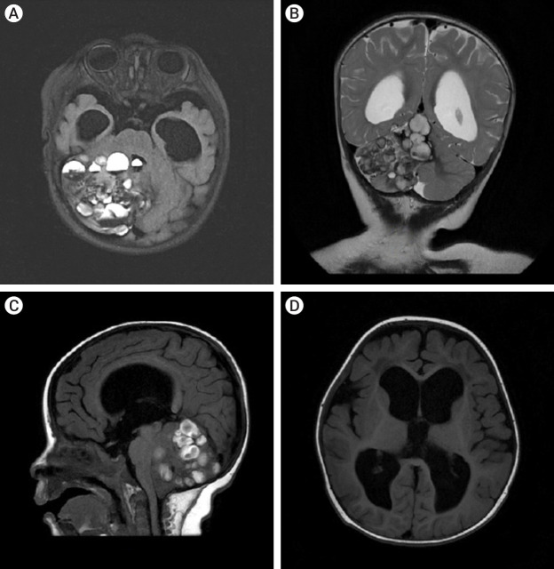 Giant cerebellar cavernous malformation in children: A case report and literature review.