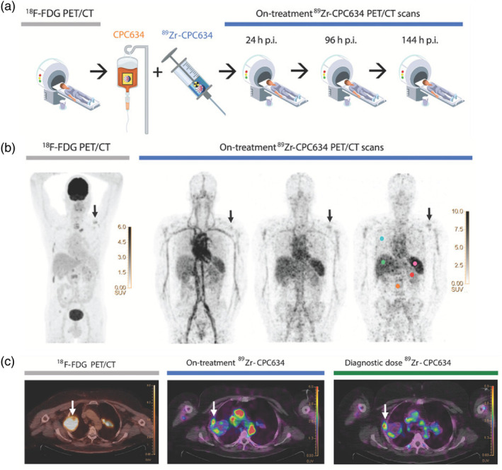Nanoscale Radiotheranostics for Cancer Treatment: From Bench to Bedside.