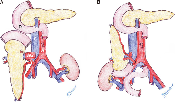 Experience from 100 consecutive pancreas transplants amidst low national transplant activity: a retrospective study at a single center in Korea.