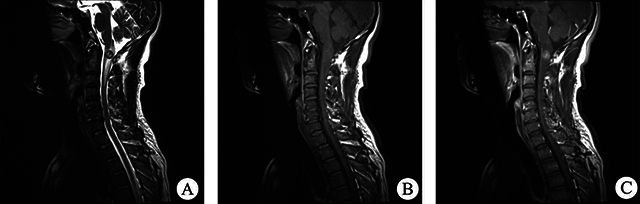 Analysis of Spinal Pilocytic Astrocytoma in 12 Case Reports and Literature Review.