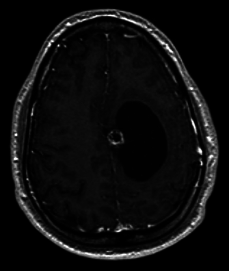 Brain metastasis mimicking a cavernous angioma as initial presentation of papillary thyroid carcinoma.
