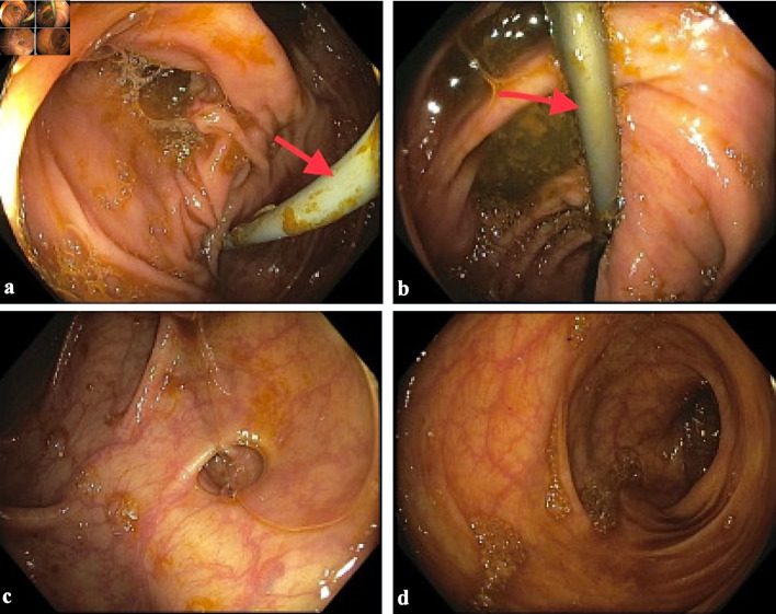 Bilio-Cecal Stent Migration Presenting as Massive Rectal Bleeding.