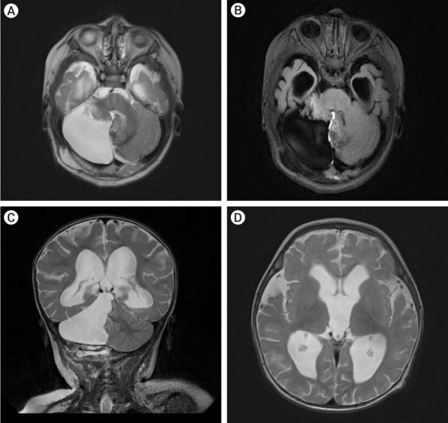 Giant cerebellar cavernous malformation in children: A case report and literature review.