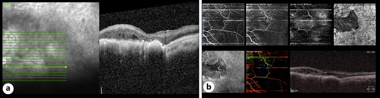 Retinal Pigment Epithelial Proliferation Secondary to Retinal Ischemia: A Case Report and Literature Review.