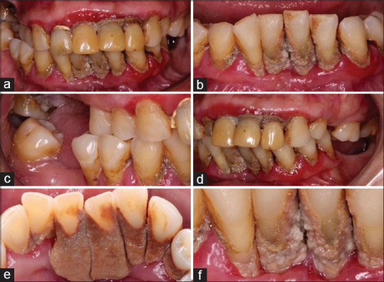 Stage IV, grade B periodontitis in a patient with coinfection with the human immunodeficiency virus, hepatitis C, and oral candidiasis.