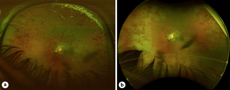 Retinal Pigment Epithelial Proliferation Secondary to Retinal Ischemia: A Case Report and Literature Review.