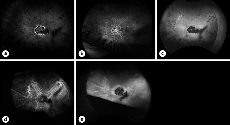 Retinal Pigment Epithelial Proliferation Secondary to Retinal Ischemia: A Case Report and Literature Review.