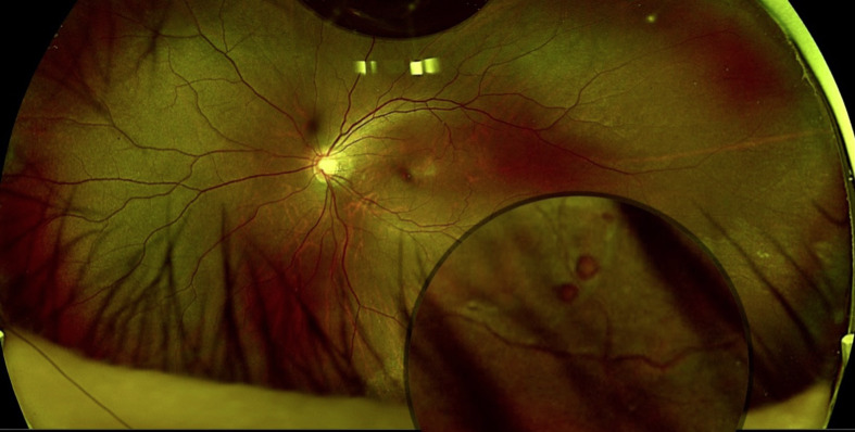 Roller Coasters and Retinal Detachment: Case Series and Review of Acceleration-Deceleration Retinal Injury.