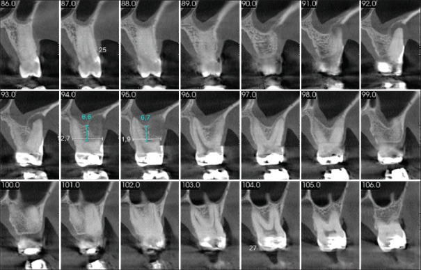 Resective and regenerative periodontal therapy for maxillary Class II furcation defect: A case report with 24-month follow-up.