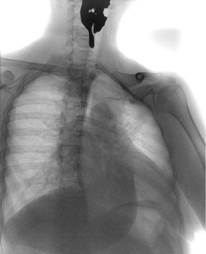Abnormal Opening in Hypopharynx by Screening Upper Endoscopy.