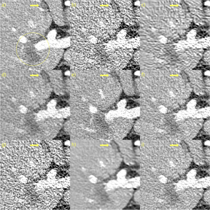 Noise suppression in photon-counting computed tomography using unsupervised Poisson flow generative models.