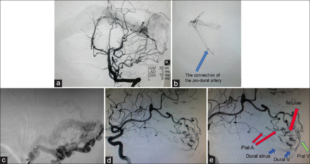Intracranial dural arteriovenous fistulas with pial arterial supply: A narrative review.