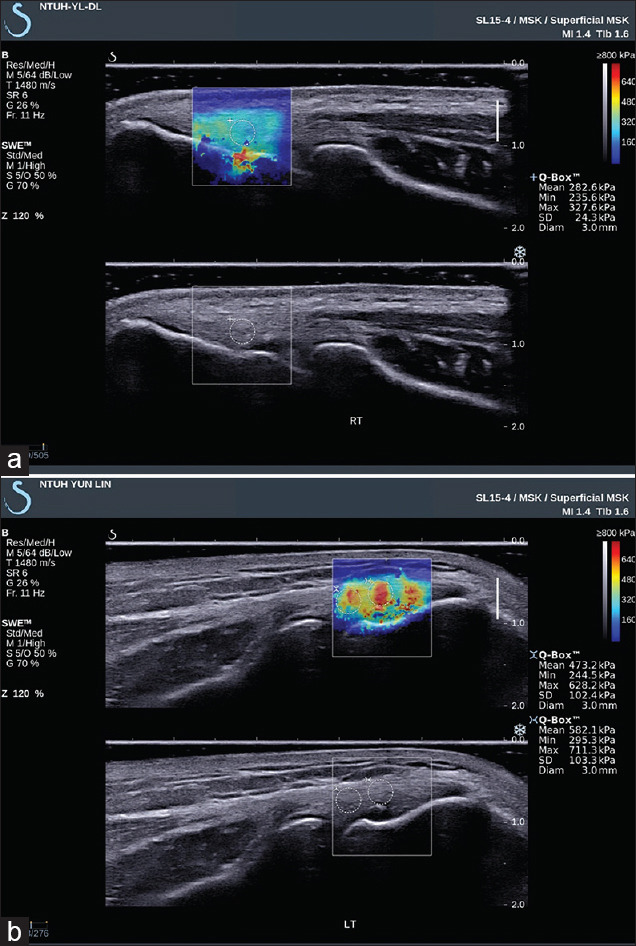Evaluation and Surveillance of Lateral Elbow Tendinopathy in Manual Workers: Identifying Elbows at Risk.