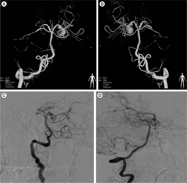 Isolated ipsilateral abducens nerve palsy and contralateral homonymous hemianopsia associated with unruptured posterior cerebral artery aneurysm: A rare neurological finding.