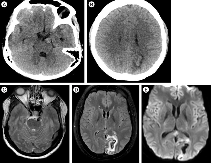 Isolated ipsilateral abducens nerve palsy and contralateral homonymous hemianopsia associated with unruptured posterior cerebral artery aneurysm: A rare neurological finding.