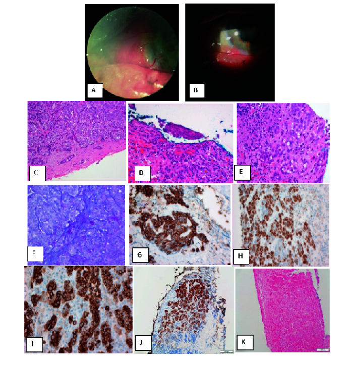 Late Metastasis in Conjunctival Adenosquamous Carcinoma.
