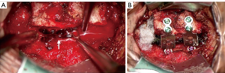 Spontaneous spinal epidural hematoma in children: a case report and literature review.