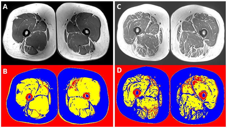 Skeletal Muscle Texture Assessment Using Ultrasonography: Comparison with Magnetic Resonance Imaging in Chronic Kidney Disease.
