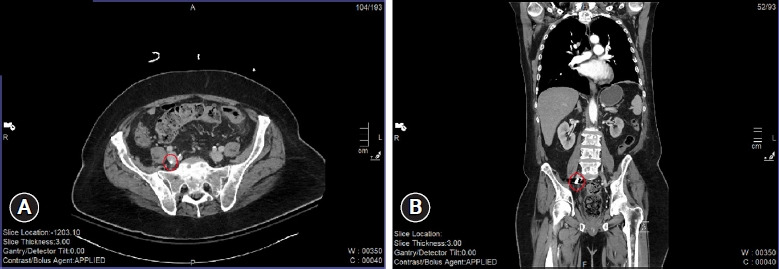 Penetrating cardiac injury resulting in a bullet embolus: a case report.