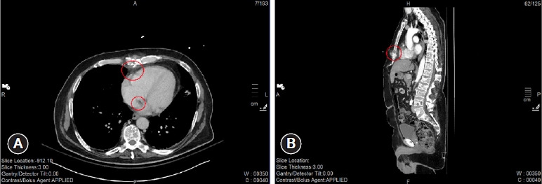 Penetrating cardiac injury resulting in a bullet embolus: a case report.