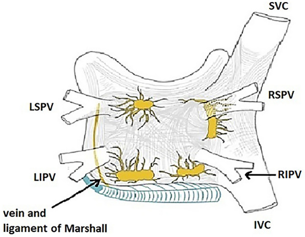 Narrative Review: Surgical and Hybrid Management of Atrial Fibrillation.